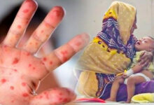 ২৪ ঘণ্টায় হামের উপসর্গে আরও ৪ শিশুর মৃত্যু, মোট প্রাণহানি ১৪৪