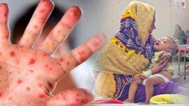 ২৪ ঘণ্টায় হামের উপসর্গে আরও ৪ শিশুর মৃত্যু, মোট প্রাণহানি ১৪৪