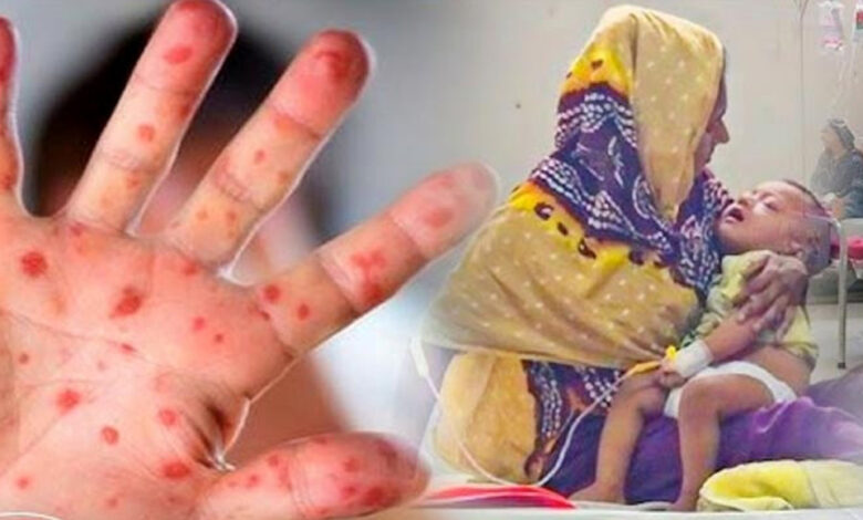 ২৪ ঘণ্টায় হামের উপসর্গে আরও ৪ শিশুর মৃত্যু, মোট প্রাণহানি ১৪৪ ২৪ ঘণ্টায় হামের উপসর্গে আরও ৪ শিশুর মৃত্যু, মোট প্রাণহানি ১৪৪